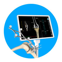 Computer-Assisted Total Knee Replacement