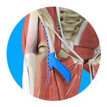 Direct Anterior Total Hip Replacement