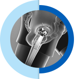 Hip Replacement - Leonard T. Buller, M.D.