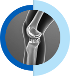 Knee Replacement - Leonard T. Buller, M.D.