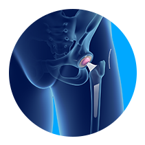 Minimally Invasive Total Hip Replacement
