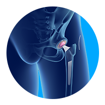 Minimally Invasive Total Hip Replacement
