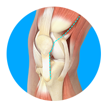 Minimally Invasive Total Knee Replacement