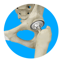 Outpatient Total Hip Replacement
