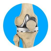 Outpatient Knee Replacement