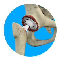 Revision/Failed Hip Replacement