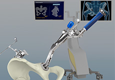 Computer-Assisted Hip Replacement