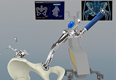 Computer-Assisted Hip Replacement