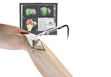 Computer-Assisted Total Knee Replacement