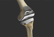 Correction of a Loose Knee Replacement