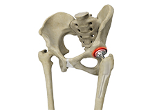 Correction of a Painful Hip Replacement