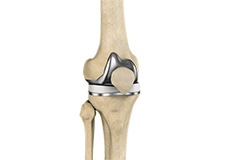 Correction of a Painful Knee Replacement