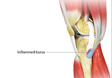 Goosefoot Bursitis of the Knee