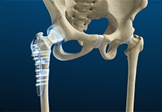 Hip Fracture Surgery