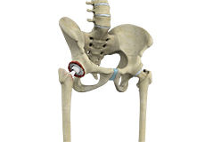 Revision Hip Replacement 