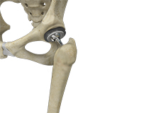 Total Hip Replacement 