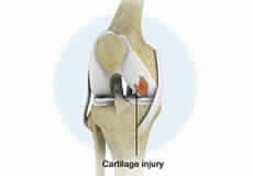 Knee Injury