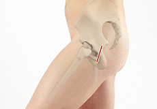 Mini-Posterior Hip Replacement