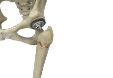 Periprosthetic Hip Fractures